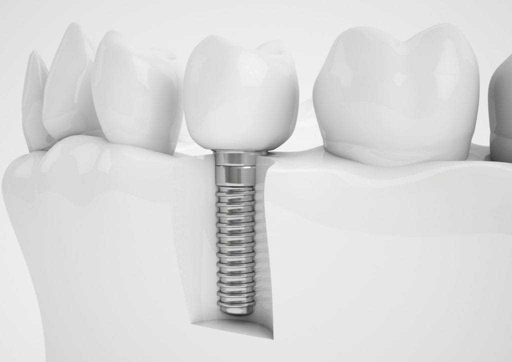32-Pearls-Seattle-Dentist-Dental-Implants
