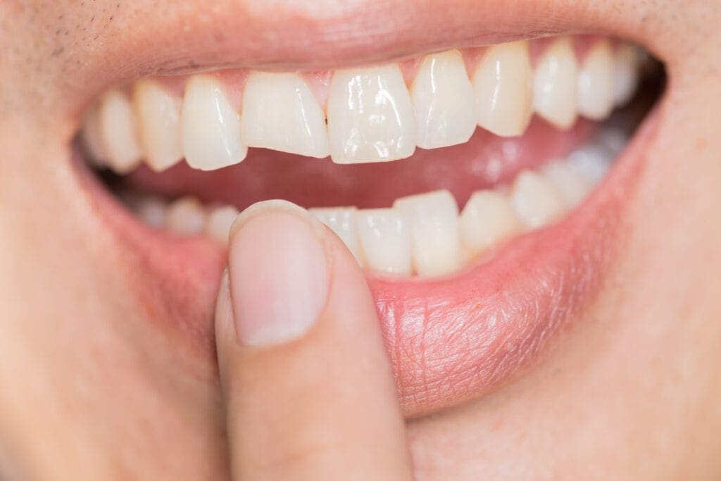 Cosmetic Bonding for teeth 32 pearls Seattle dentist