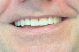 After Veneers, 32 Pearls Seattle Dentistry