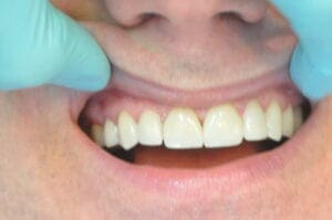 After Veneers, 32 Pearls Seattle Dentistry