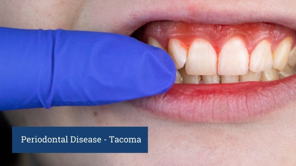 Periodontal disease tacoma