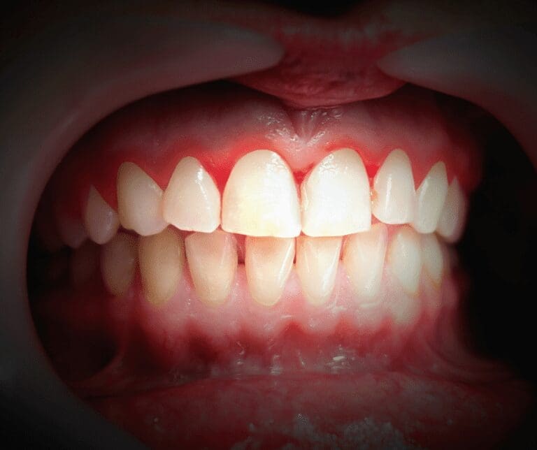 receding gums treatment in tacoma