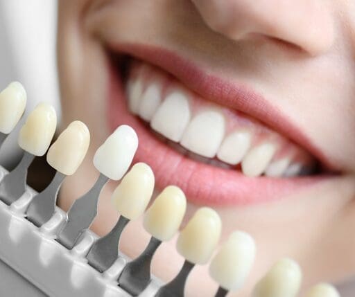 Cosmetic bonding matches the color, shape, and size of your tooth.