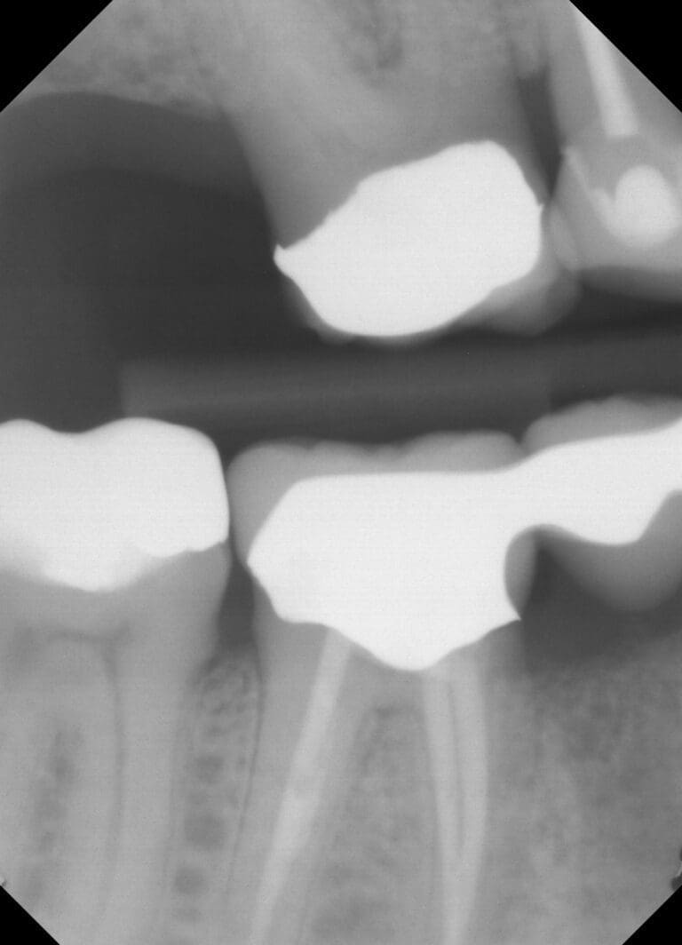 Root Canal