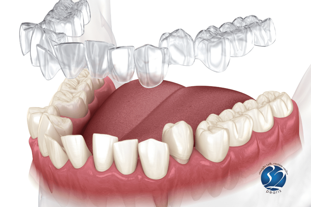 Overbite Improvements With Invisalign